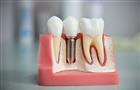 Что делать, если не хватает зуба, или Какой метод имплантации выбрать