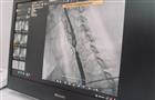 Кировские хирурги провели уникальную операцию при помощи ангиографического комплекса