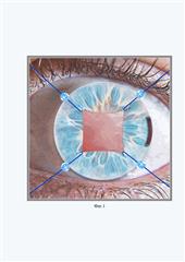 Пензенские ученые предложили инновационный способ лечения катаракты при сопутствующих глазных заболеваниях