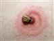 В регионе зарегистрировано уже более 40 укусов клещей, обнаружен энцефалит